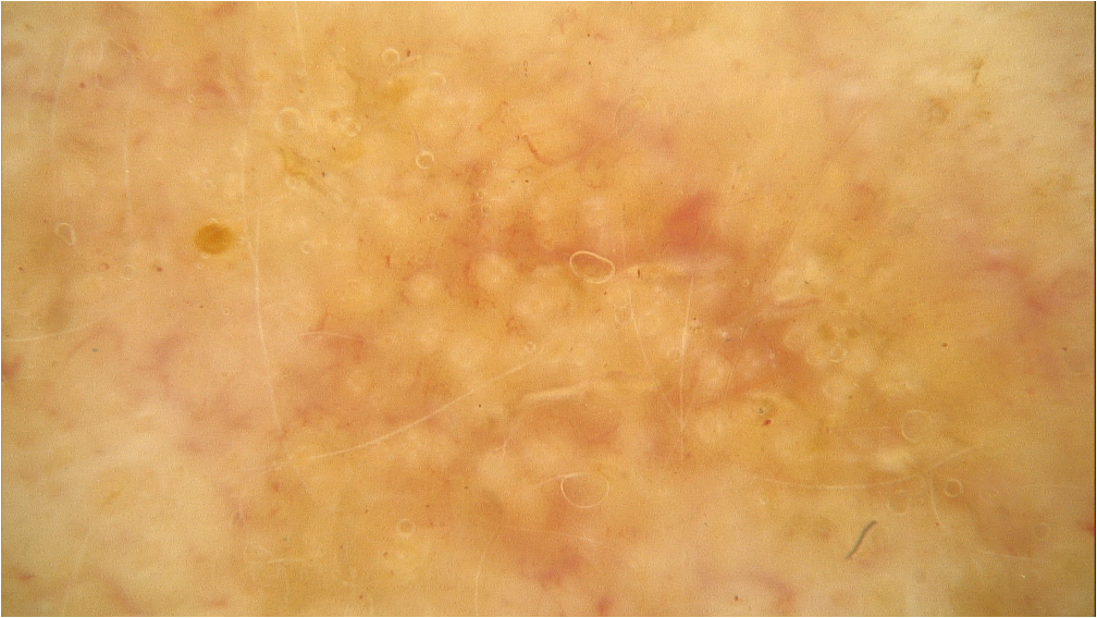 Actinic keratosis diagnostics