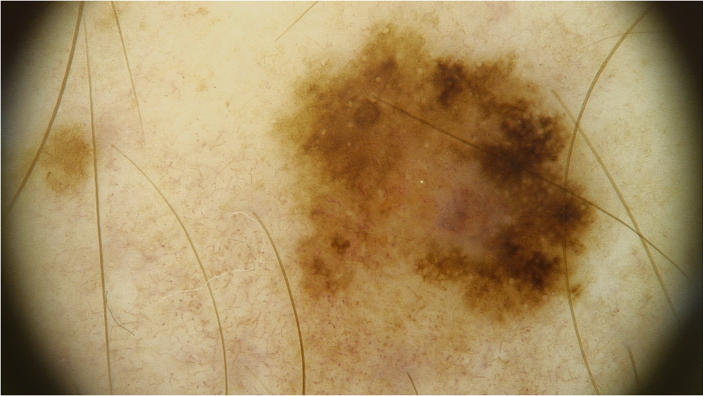Different pigmented lesion patterns
