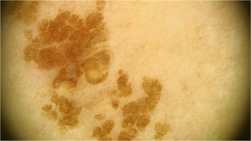 Seborrheic keratosis lesion
