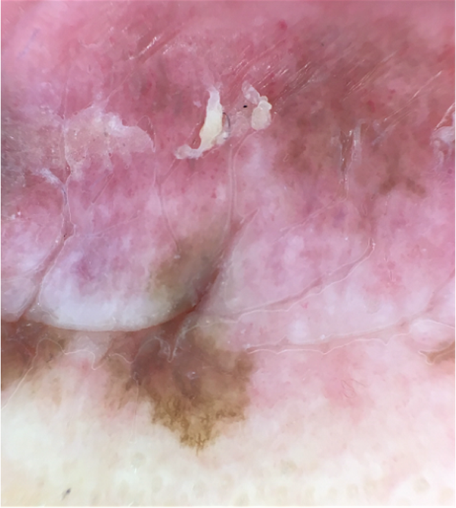 Pigmented lesion on oral mucosa